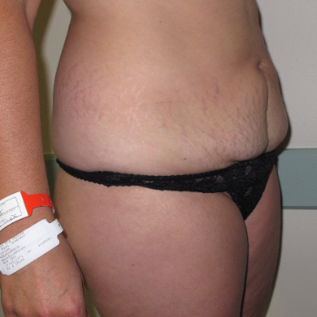 Side view of female patient prior to abdominoplasty surgery
